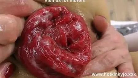 Extreme Anal Prolapse and Public Dildo/Fisting Action!