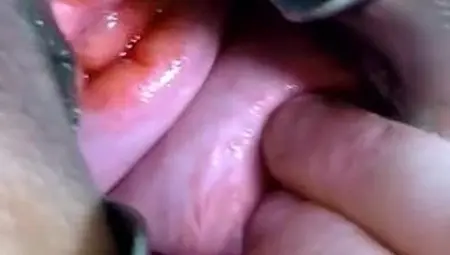 Exl-032: Huge Speculum in Ass N Pussy. Huge Prolapse and Huge Cervix. Full Extremelatina Scene Exl-032