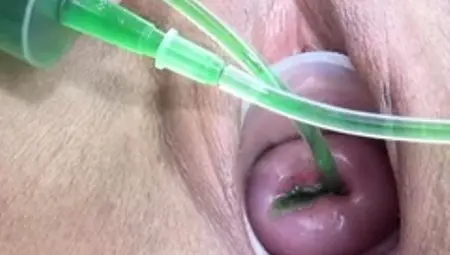 Cervix and Pee Hole Inflation with Injections for Japan Lesb