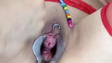 Mature Woman Peehole Endoscope Camera in Bladder with Balls
